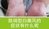 北京白癜风权威专家讲解肢端型白癜风的症状有哪些?